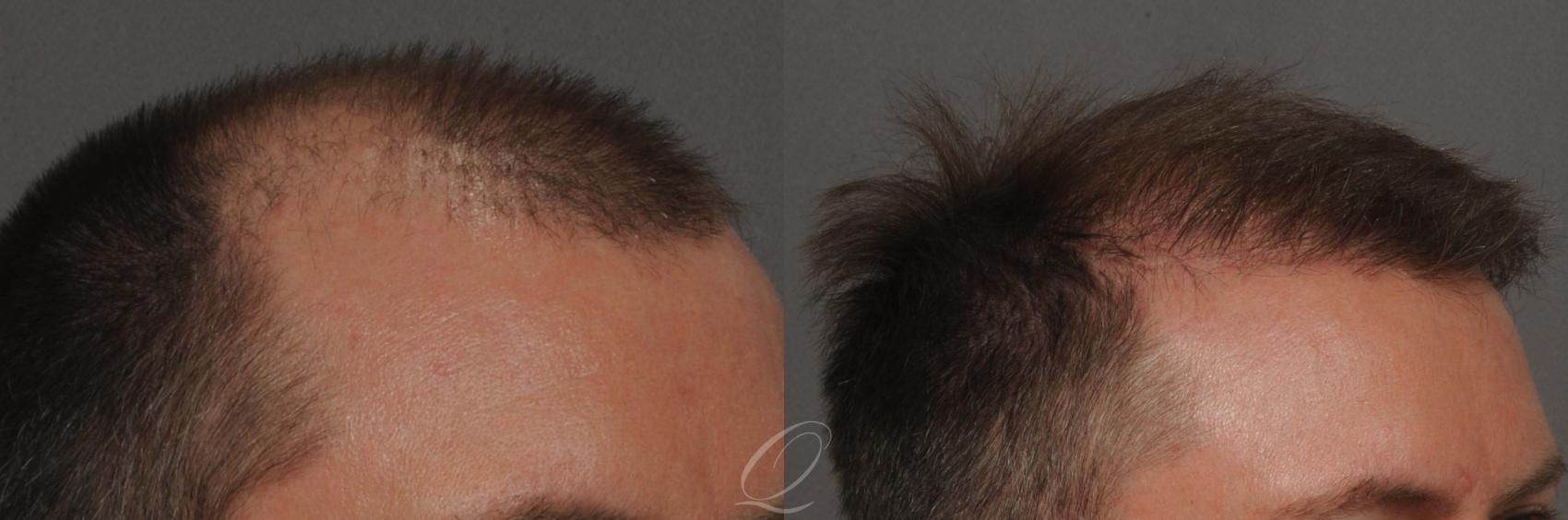 FUT Case 1020 Before & After View #2 | Rochester, NY | Quatela Center for Hair Restoration