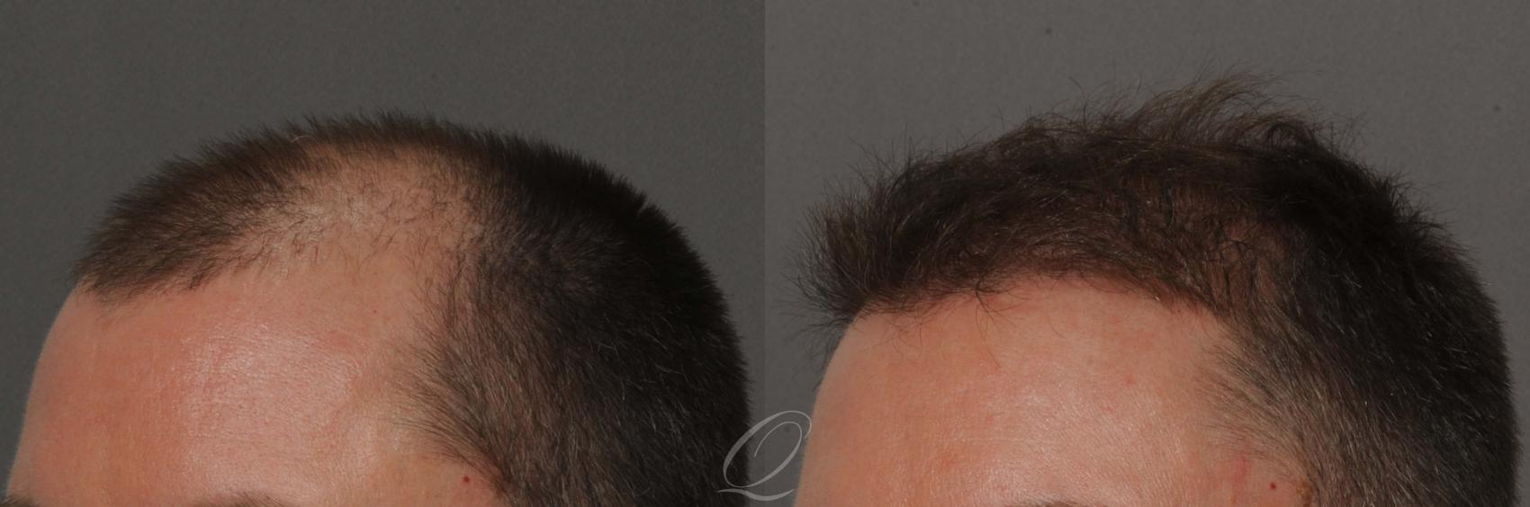 FUT Case 1020 Before & After View #3 | Rochester, Buffalo, & Syracuse, NY | Quatela Center for Hair Restoration