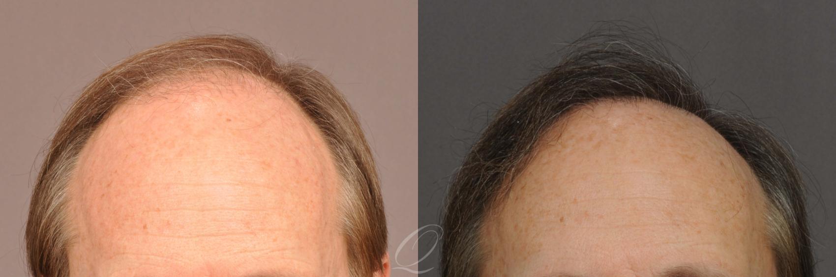 FUT Case 1021 Before & After View #1 | Rochester, NY | Quatela Center for Hair Restoration