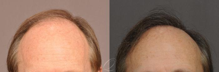 Male Hairline and Central Density Hair Restoration Case 1021 Before & After View #1 | Serving Rochester, Syracuse & Buffalo, NY | Quatela Center for Plastic Surgery