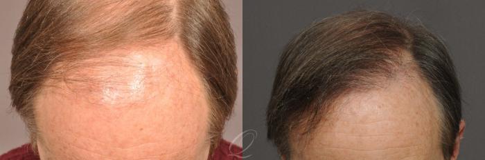Male Hairline and Central Density Hair Restoration Case 1021 Before & After View #2 | Serving Rochester, Syracuse & Buffalo, NY | Quatela Center for Plastic Surgery
