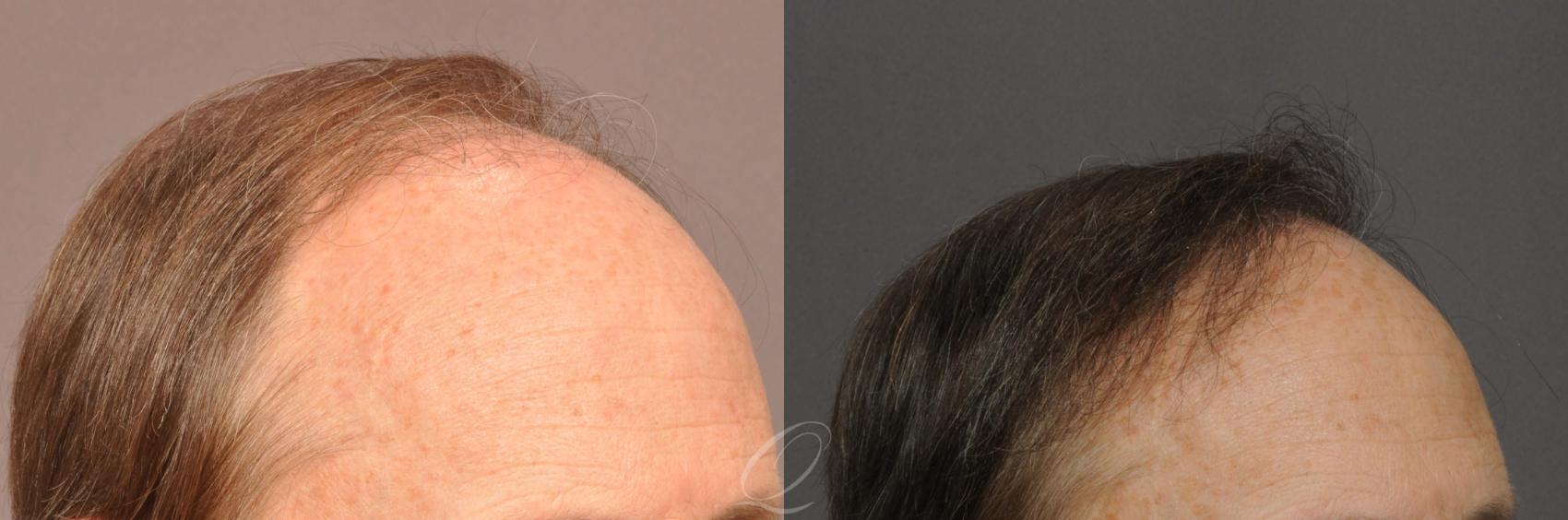 FUT Case 1021 Before & After View #3 | Rochester, Buffalo, & Syracuse, NY | Quatela Center for Hair Restoration