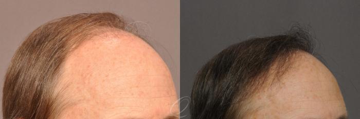 Male Hairline and Central Density Hair Restoration Case 1021 Before & After View #3 | Serving Rochester, Syracuse & Buffalo, NY | Quatela Center for Plastic Surgery
