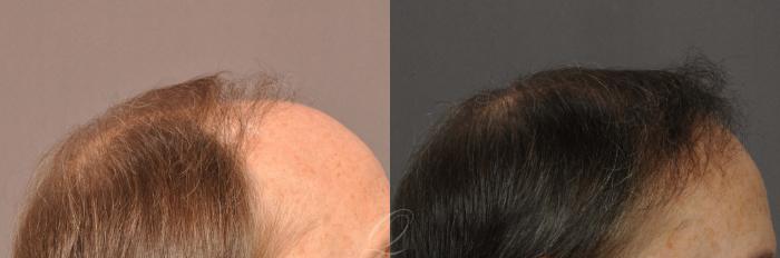 Male Hairline and Central Density Hair Restoration Case 1021 Before & After View #4 | Serving Rochester, Syracuse & Buffalo, NY | Quatela Center for Plastic Surgery