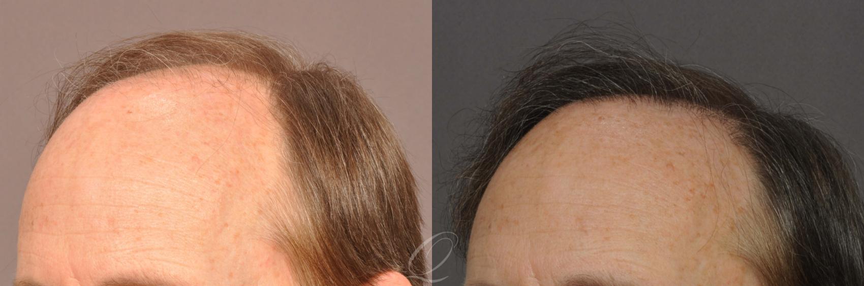 FUT Case 1021 Before & After View #5 | Rochester, Buffalo, & Syracuse, NY | Quatela Center for Hair Restoration