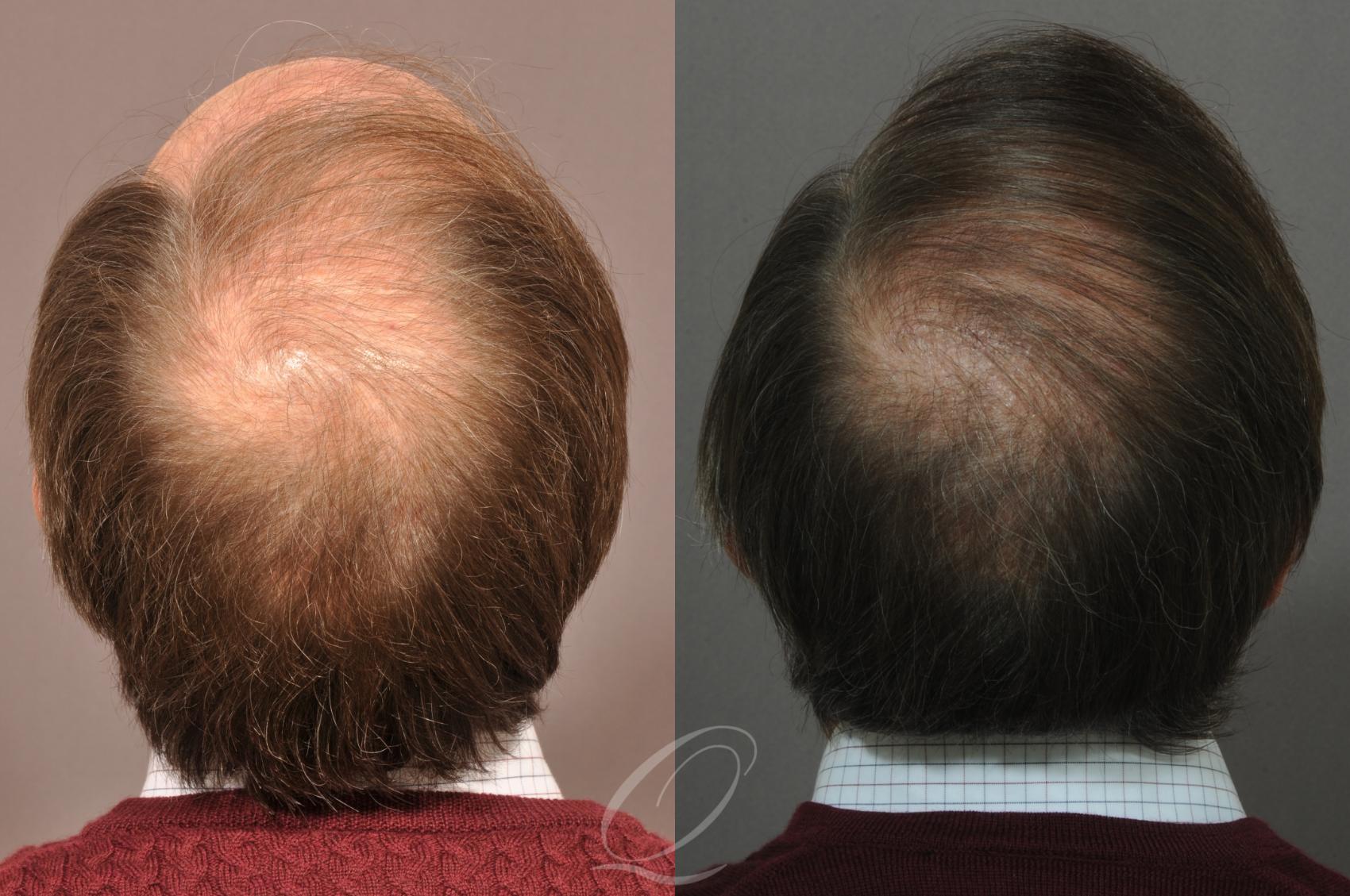 FUT Case 1021 Before & After View #6 | Rochester, Buffalo, & Syracuse, NY | Quatela Center for Hair Restoration