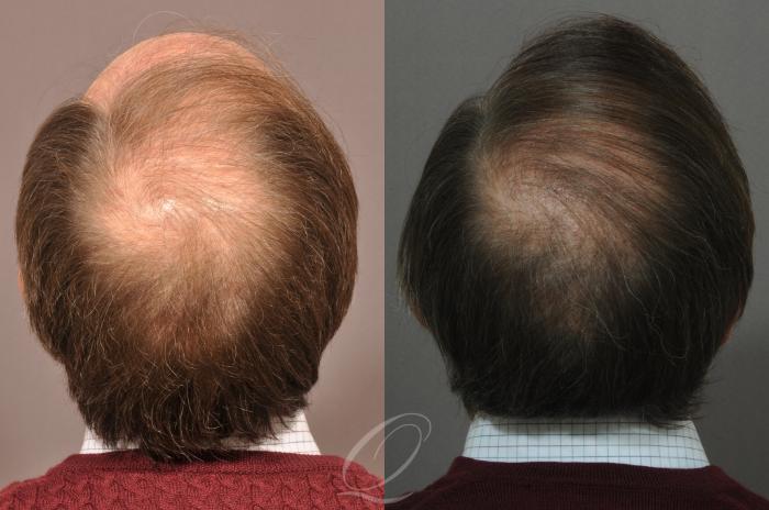 Male Hairline and Central Density Hair Restoration Case 1021 Before & After View #6 | Serving Rochester, Syracuse & Buffalo, NY | Quatela Center for Plastic Surgery