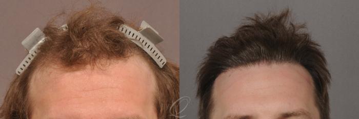 Before & After Male Hairline and Central Density Hair Restoration Case 1023 View #1 View in Rochester, Buffalo, & Syracuse, NY
