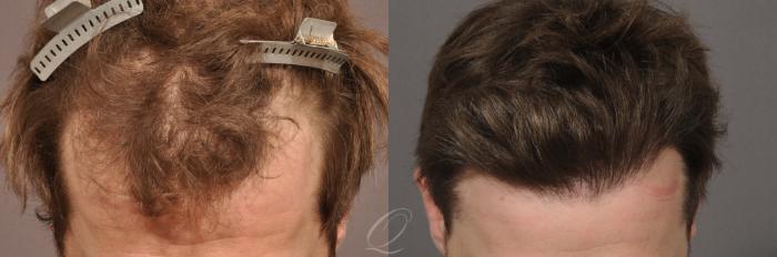 Before & After Male Hairline and Central Density Hair Restoration Case 1023 View #2 View in Rochester, Buffalo, & Syracuse, NY