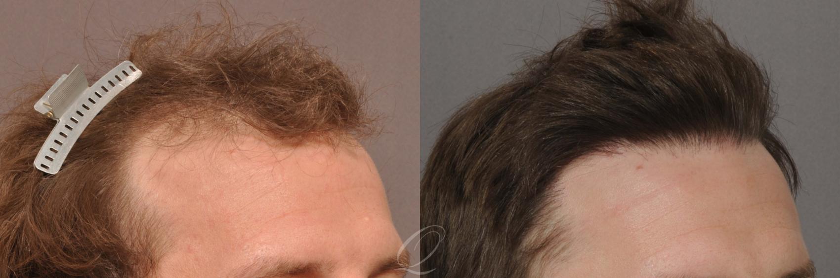 FUT Case 1023 Before & After View #3 | Rochester, NY | Quatela Center for Hair Restoration