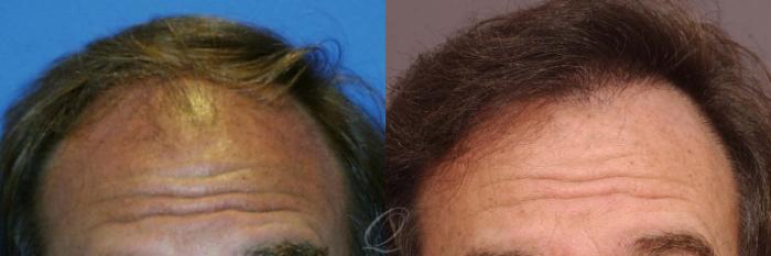 FUT Case 1024 Before & After View #1 | Rochester, Buffalo, & Syracuse, NY | Quatela Center for Hair Restoration