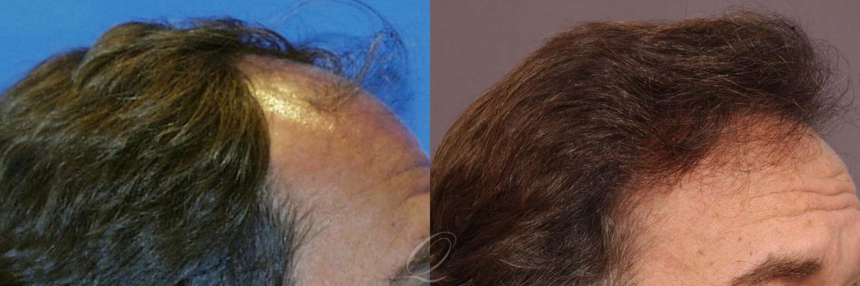 FUT Case 1024 Before & After View #3 | Rochester, Buffalo, & Syracuse, NY | Quatela Center for Hair Restoration