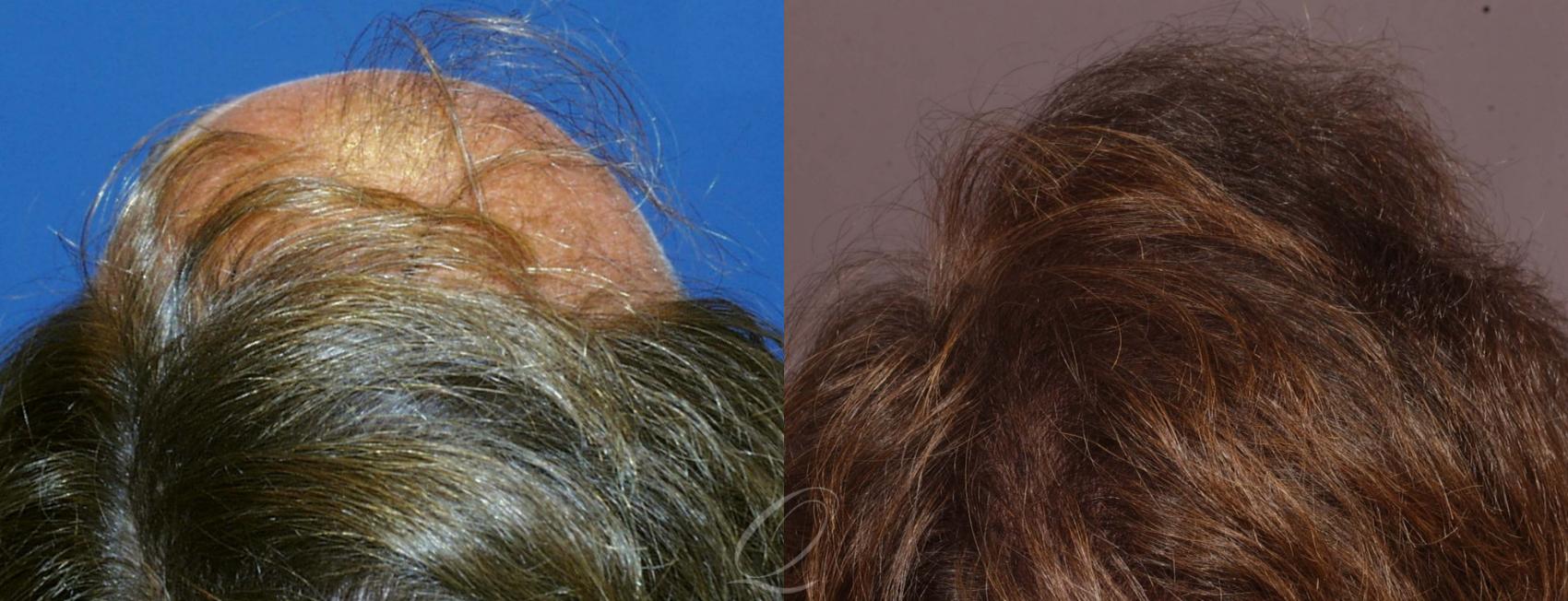 FUT Case 1024 Before & After View #4 | Rochester, Buffalo, & Syracuse, NY | Quatela Center for Hair Restoration