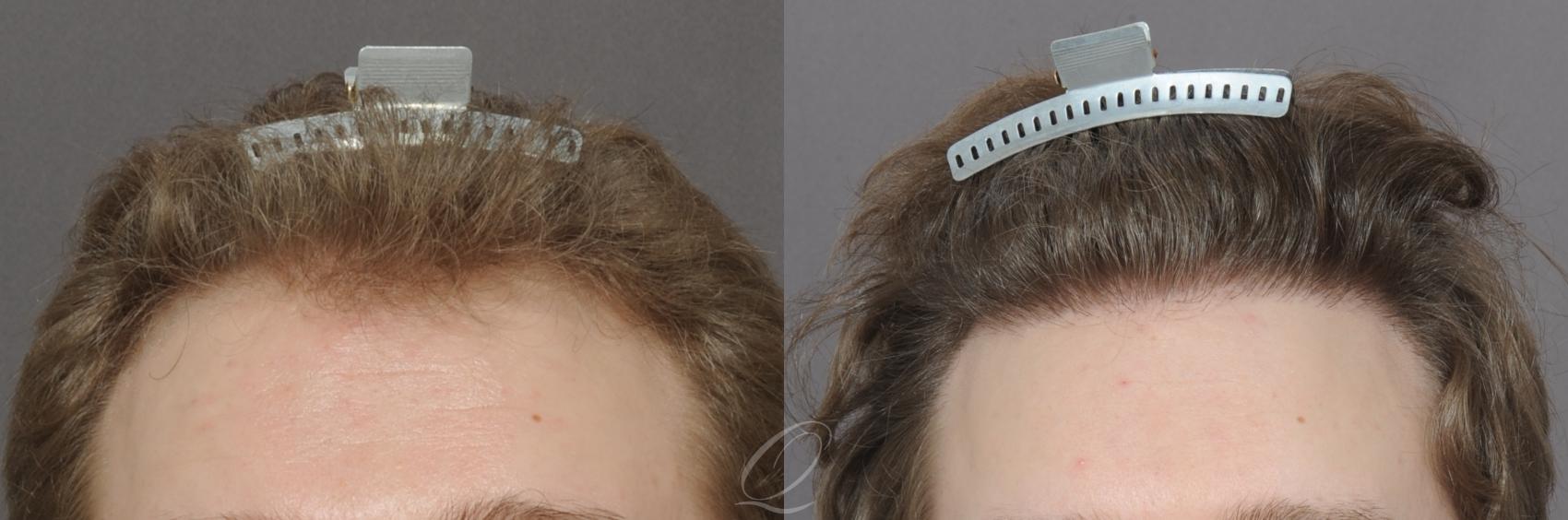 FUT Case 1025 Before & After View #1 | Rochester, Buffalo, & Syracuse, NY | Quatela Center for Hair Restoration