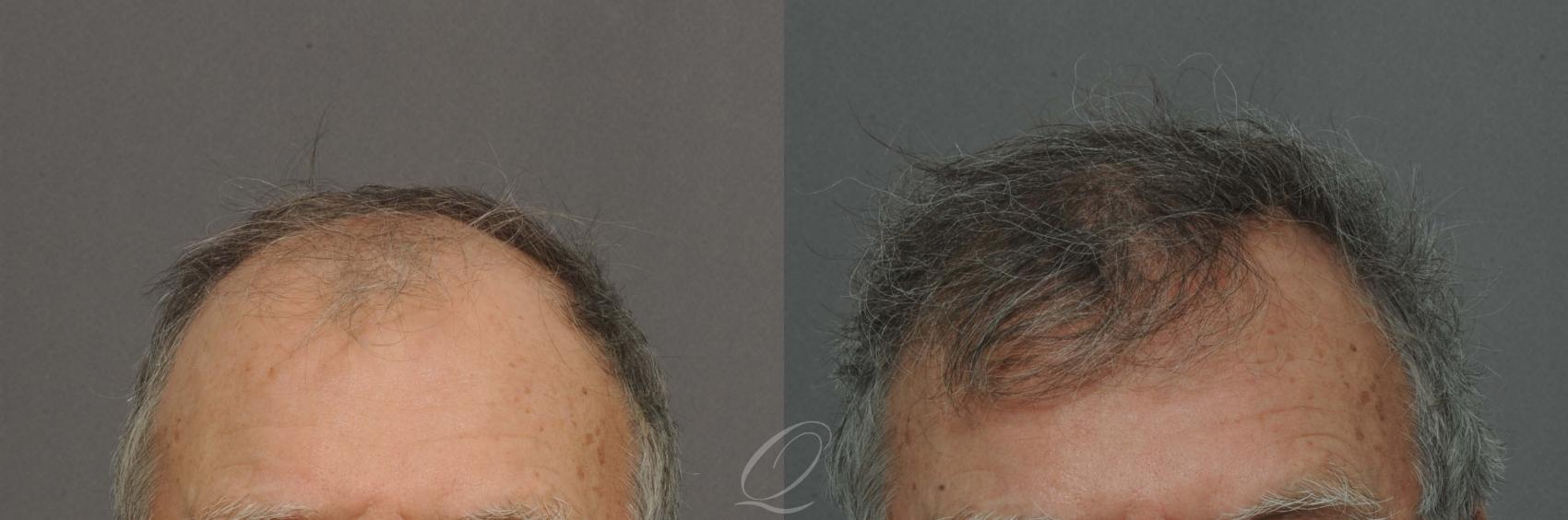 FUT Case 1026 Before & After View #1 | Rochester, Buffalo, & Syracuse, NY | Quatela Center for Hair Restoration