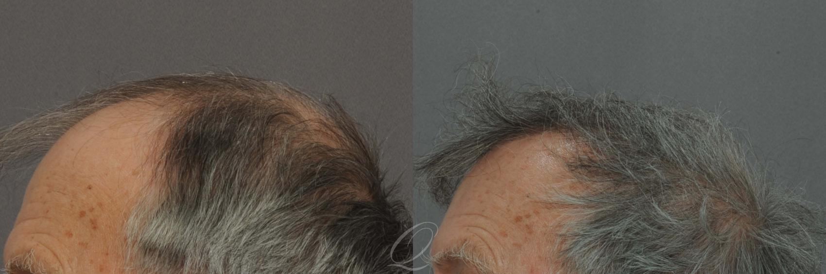 FUT Case 1026 Before & After View #2 | Rochester, NY | Quatela Center for Hair Restoration