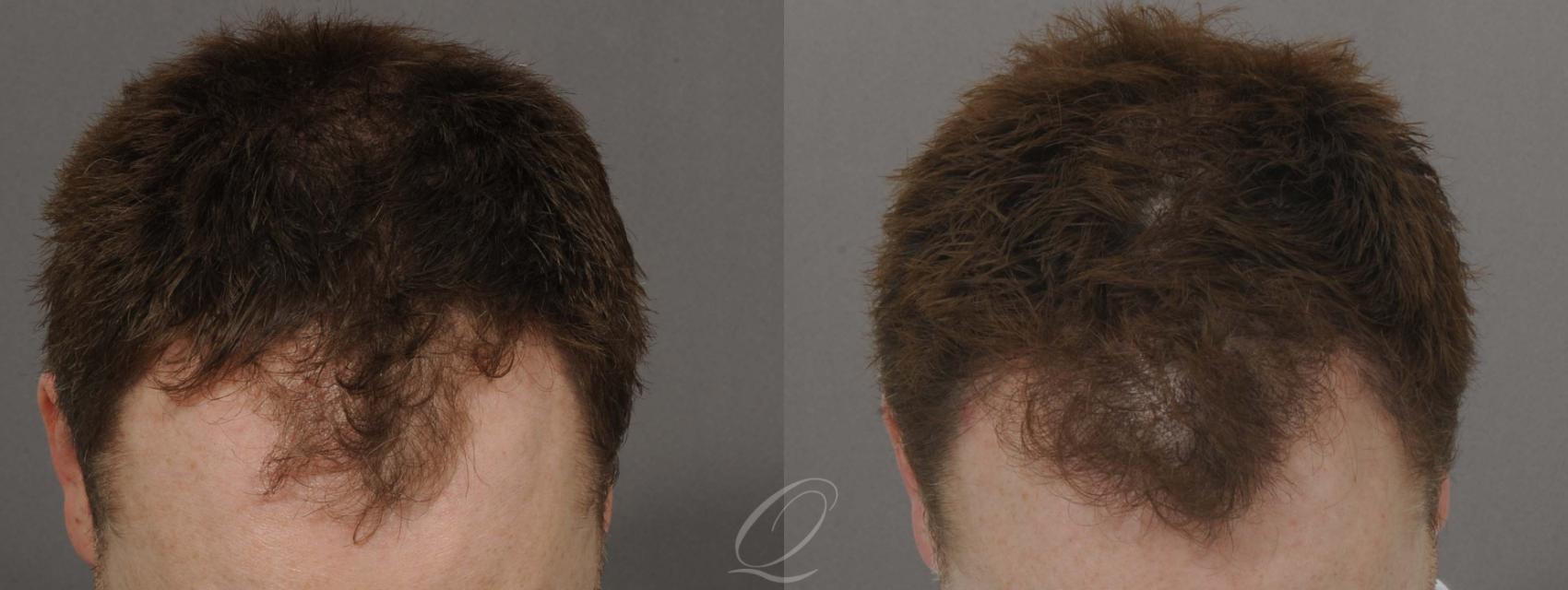 Male Hairline and Central Density Hair Restoration Case 1027 Before & After View #1 | Rochester, Buffalo, & Syracuse, NY | Quatela Center for Hair Restoration