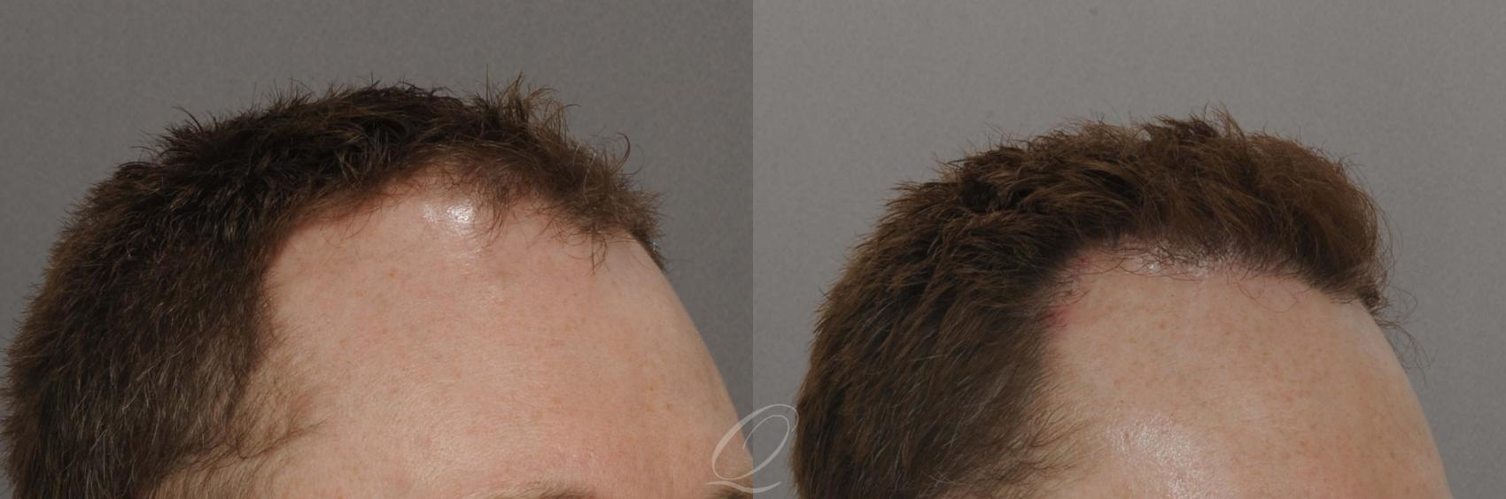 Male Hairline and Central Density Hair Restoration Case 1027 Before & After View #2 | Rochester, Buffalo, & Syracuse, NY | Quatela Center for Hair Restoration