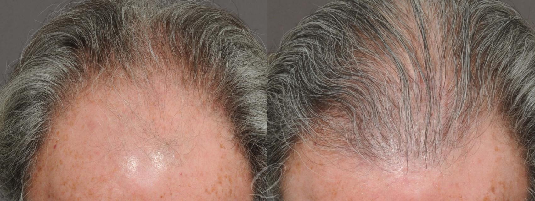 FUT Case 1028 Before & After View #1 | Rochester, Buffalo, & Syracuse, NY | Quatela Center for Hair Restoration