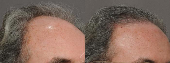Male Hairline and Central Density Hair Restoration Case 1028 Before & After View #2 | Serving Rochester, Syracuse & Buffalo, NY | Quatela Center for Plastic Surgery