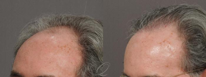 Male Hairline and Central Density Hair Restoration Case 1028 Before & After View #3 | Serving Rochester, Syracuse & Buffalo, NY | Quatela Center for Plastic Surgery