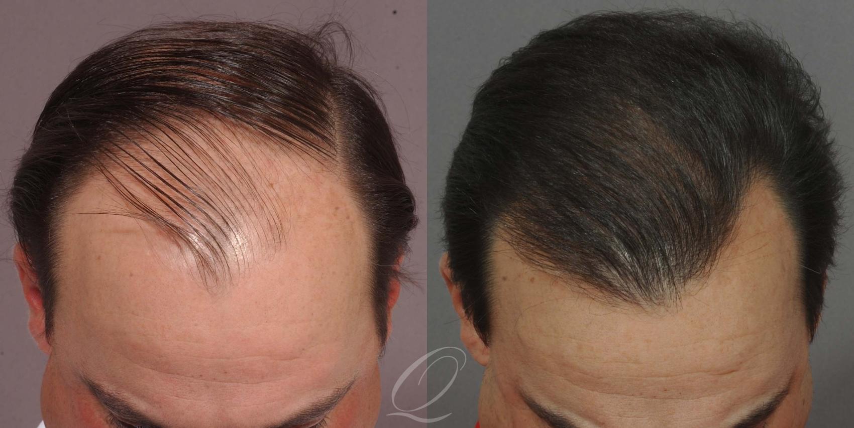 Male Hairline and Central Density Hair Restoration Case 1029 Before & After View #1 | Rochester, Buffalo, & Syracuse, NY | Quatela Center for Hair Restoration