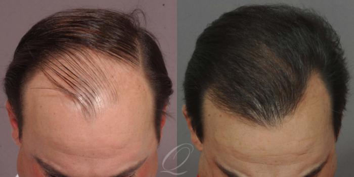 FUT Case 1029 Before & After View #1 | Rochester, Buffalo, & Syracuse, NY | Quatela Center for Hair Restoration