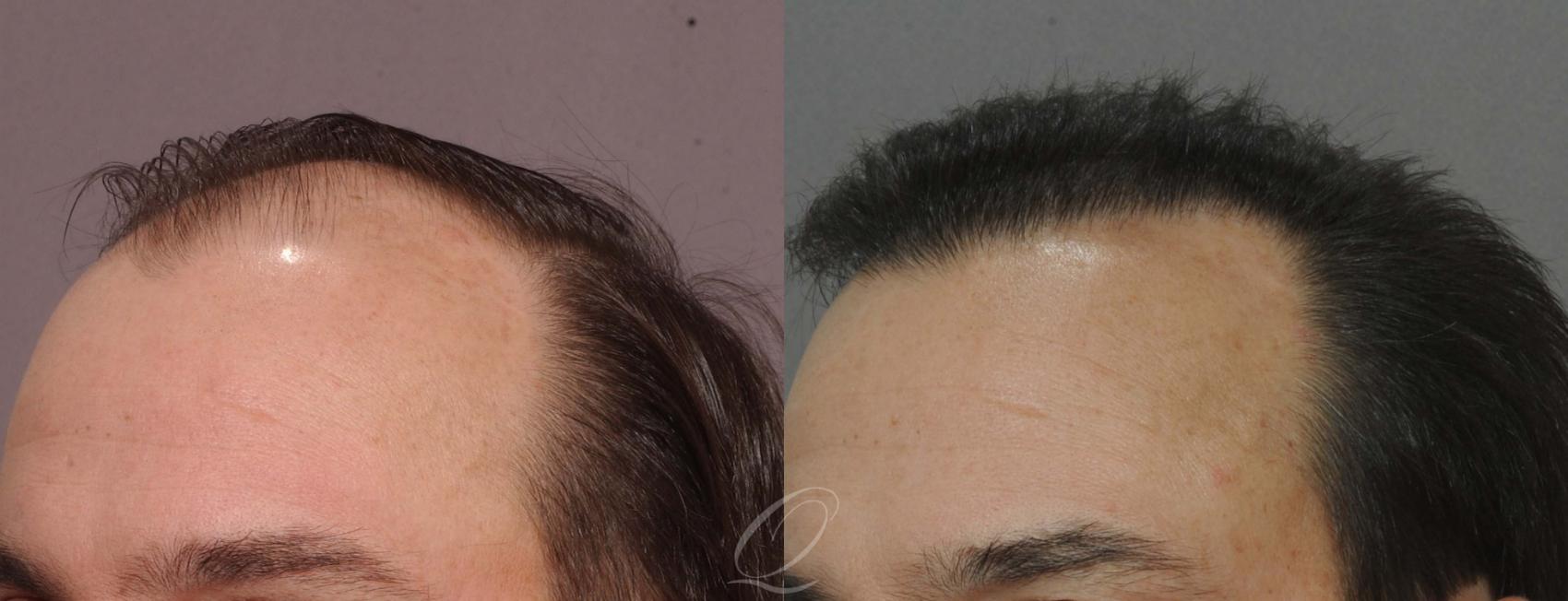 Male Hairline and Central Density Hair Restoration Case 1029 Before & After View #2 | Rochester, Buffalo, & Syracuse, NY | Quatela Center for Hair Restoration
