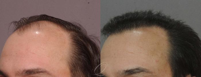 FUT Case 1029 Before & After View #2 | Rochester, Buffalo, & Syracuse, NY | Quatela Center for Hair Restoration