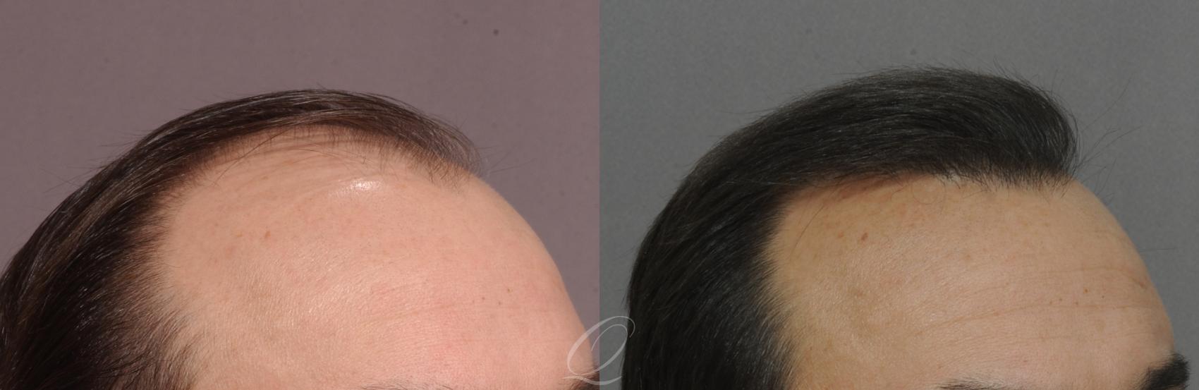 FUT Case 1029 Before & After View #3 | Rochester, NY | Quatela Center for Hair Restoration