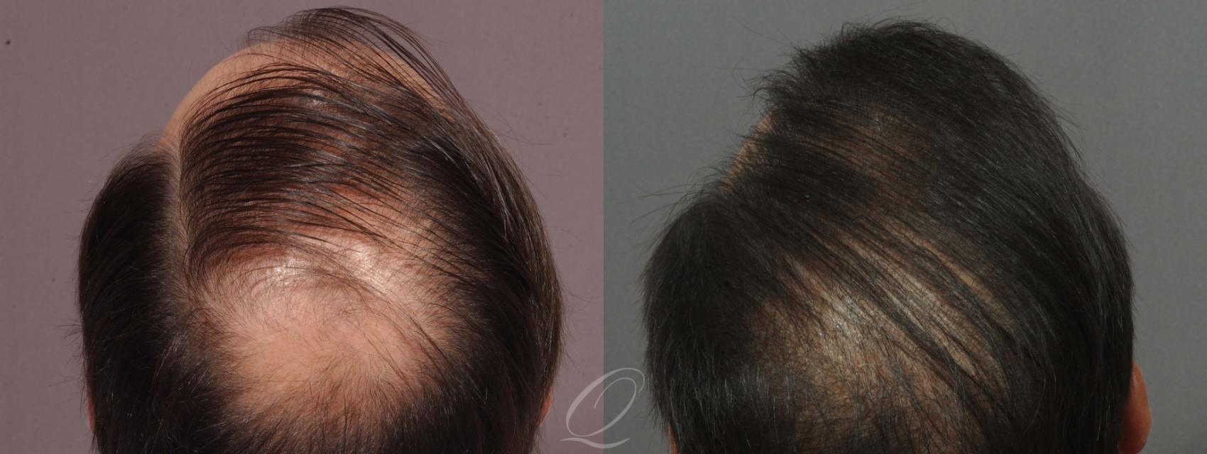 FUT Case 1029 Before & After View #4 | Rochester, NY | Quatela Center for Hair Restoration