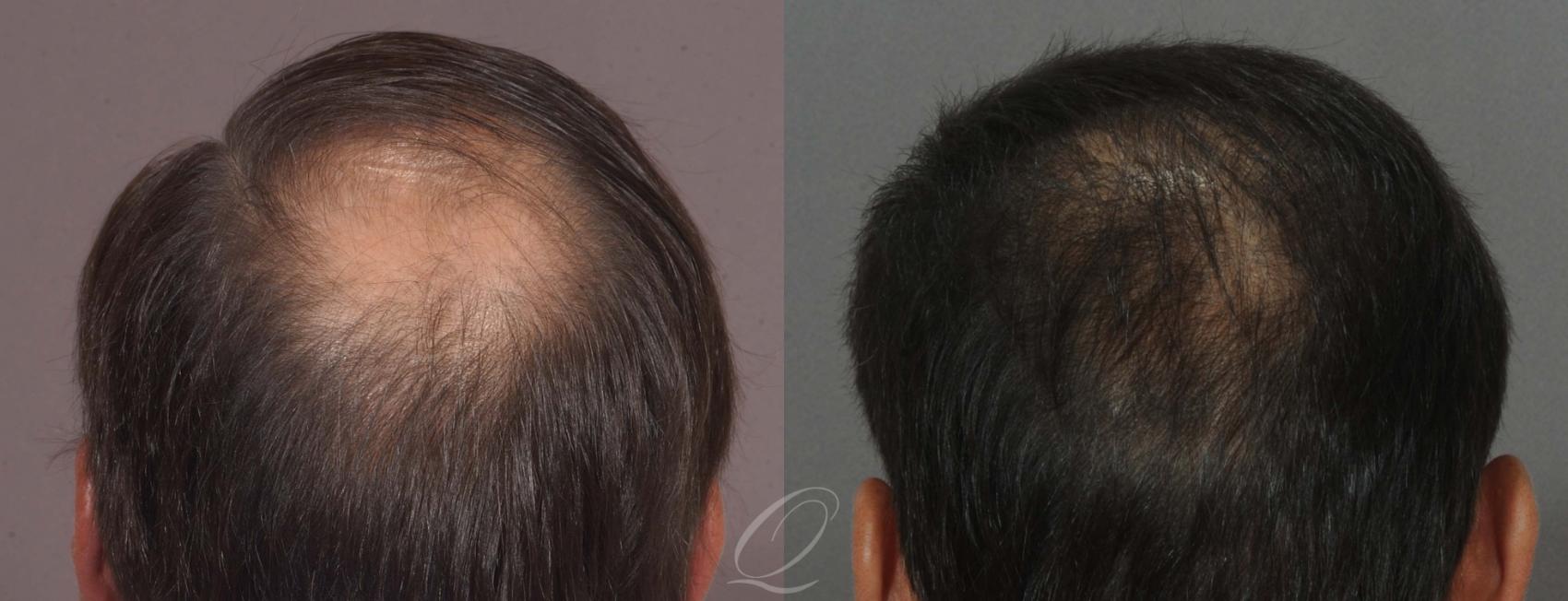 FUT Case 1029 Before & After View #5 | Rochester, Buffalo, & Syracuse, NY | Quatela Center for Hair Restoration