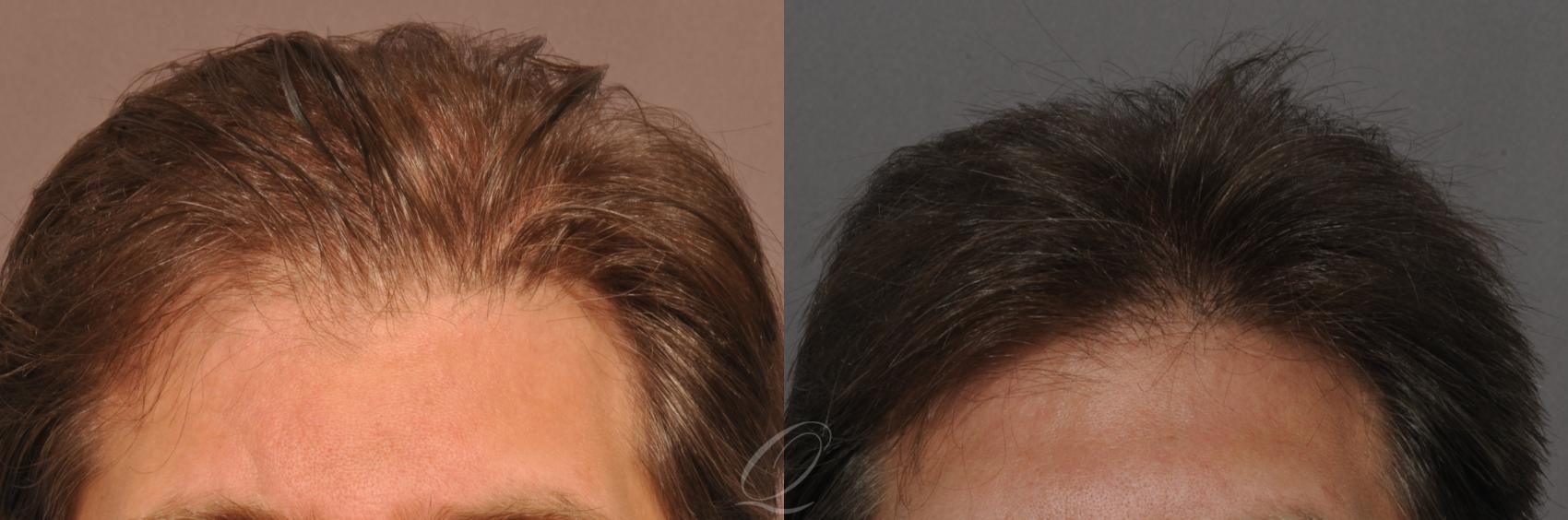 FUT Case 1030 Before & After View #1 | Rochester, Buffalo, & Syracuse, NY | Quatela Center for Hair Restoration