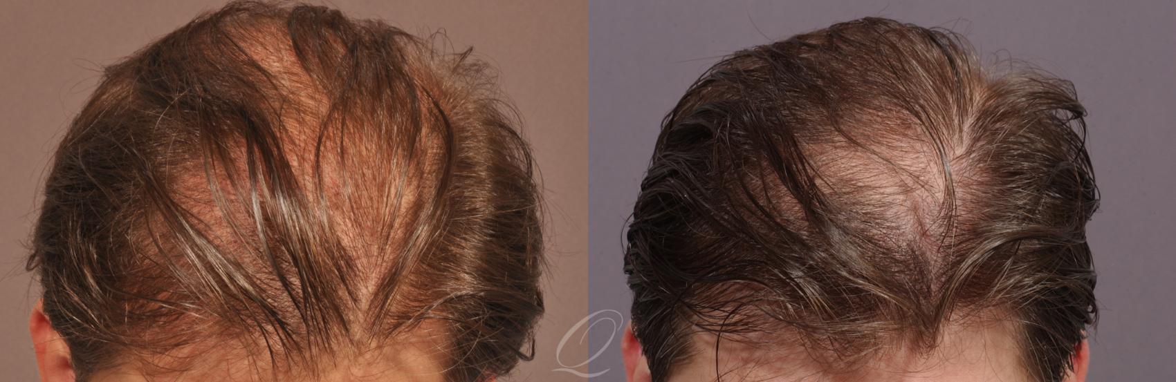 FUT Case 1030 Before & After View #2 | Rochester, NY | Quatela Center for Hair Restoration