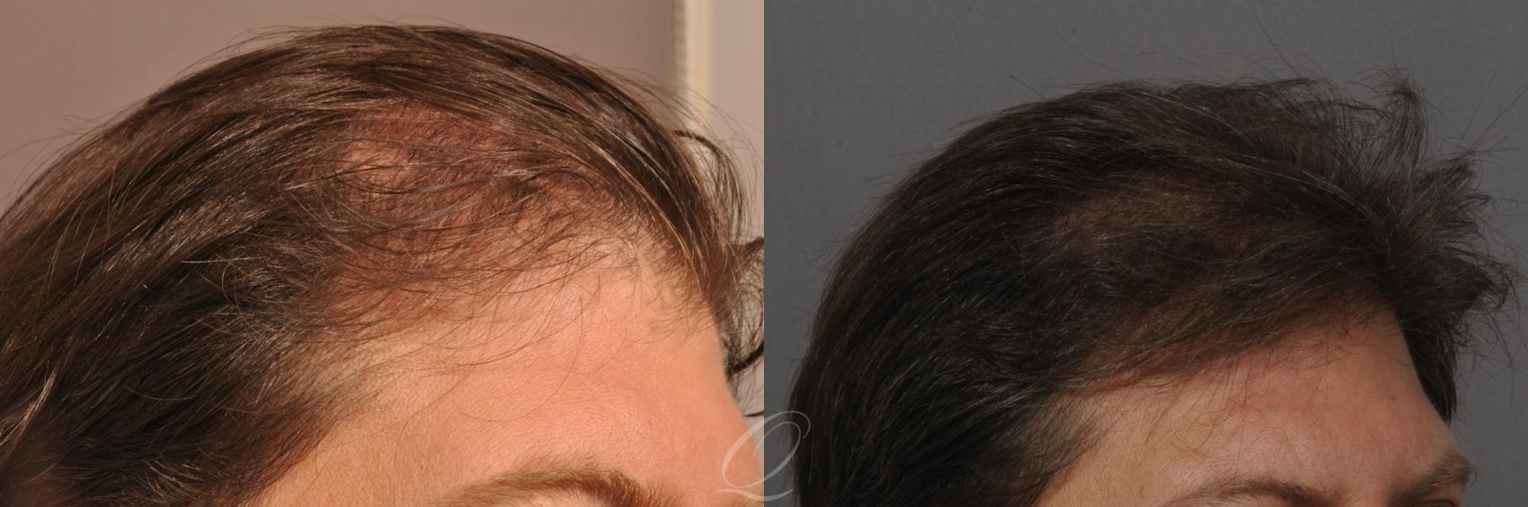 FUT Case 1030 Before & After View #3 | Rochester, Buffalo, & Syracuse, NY | Quatela Center for Hair Restoration
