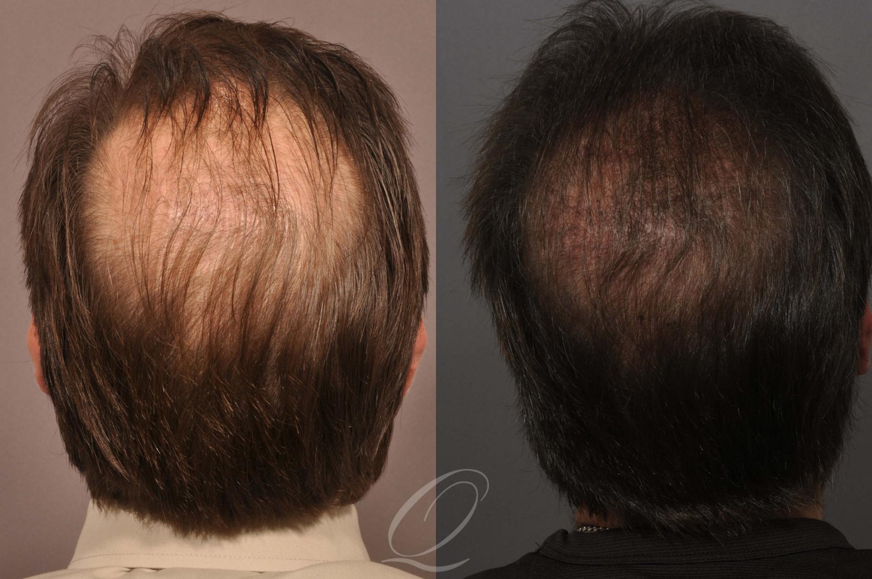 FUT Case 1030 Before & After View #4 | Rochester, NY | Quatela Center for Hair Restoration