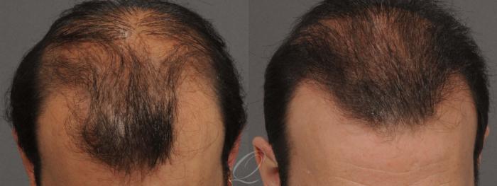 Male Hairline and Central Density Hair Restoration Case 1031 Before & After View #1 | Rochester, Buffalo, & Syracuse, NY | Quatela Center for Hair Restoration