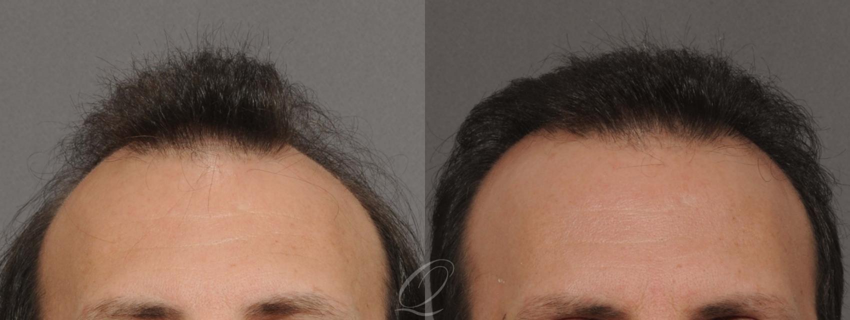 FUT Case 1031 Before & After View #2 | Rochester, NY | Quatela Center for Hair Restoration