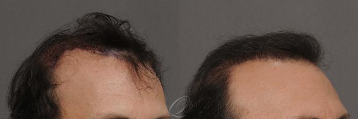 FUT Case 1031 Before & After View #3 | Rochester, Buffalo, & Syracuse, NY | Quatela Center for Hair Restoration