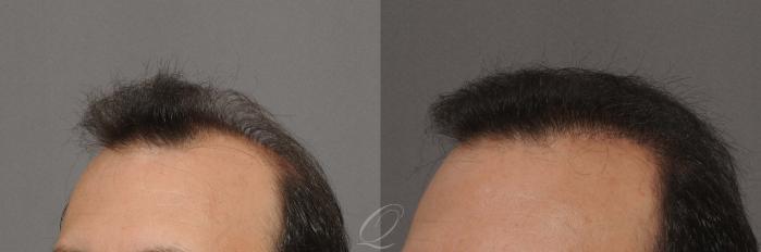 FUT Case 1031 Before & After View #4 | Rochester, Buffalo, & Syracuse, NY | Quatela Center for Hair Restoration