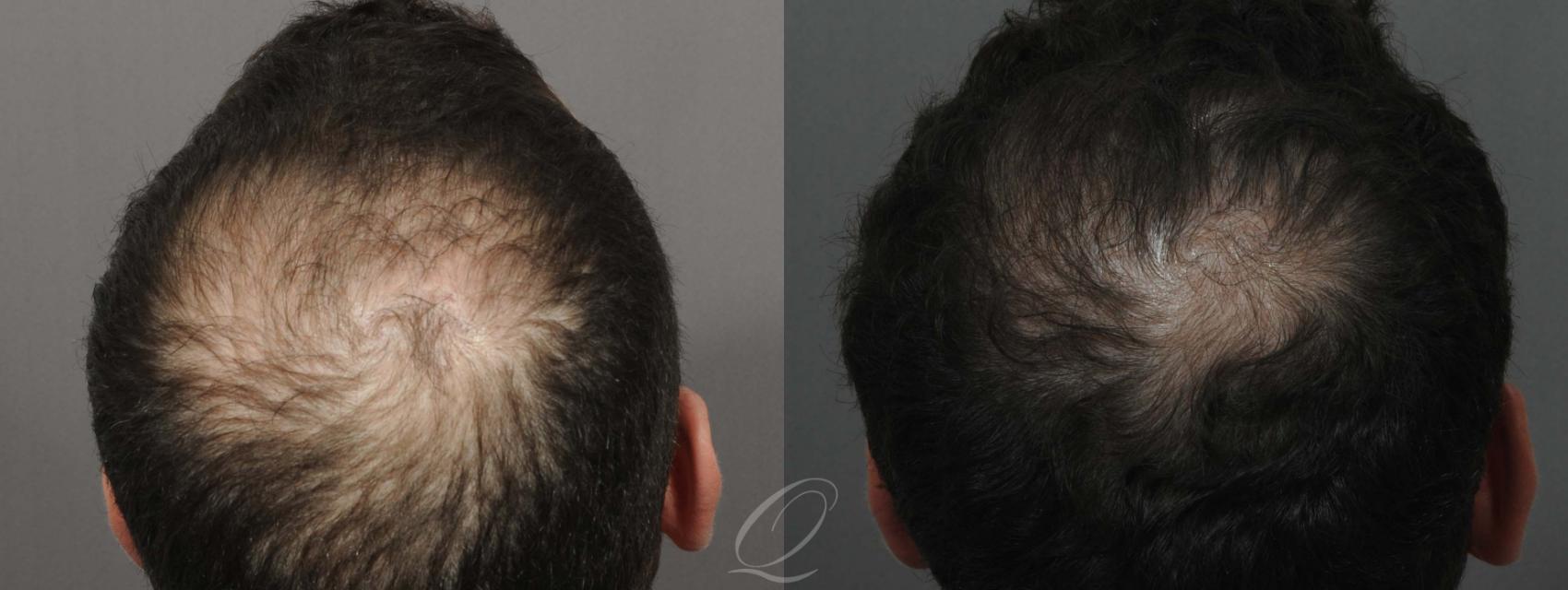 Male Crown Hair Restoration Case 1032 Before & After View #1 | Rochester, Buffalo, & Syracuse, NY | Quatela Center for Hair Restoration