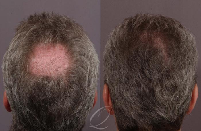 Male Crown Hair Restoration Case 1033 Before & After View #1 | Rochester, Buffalo, & Syracuse, NY | Quatela Center for Hair Restoration