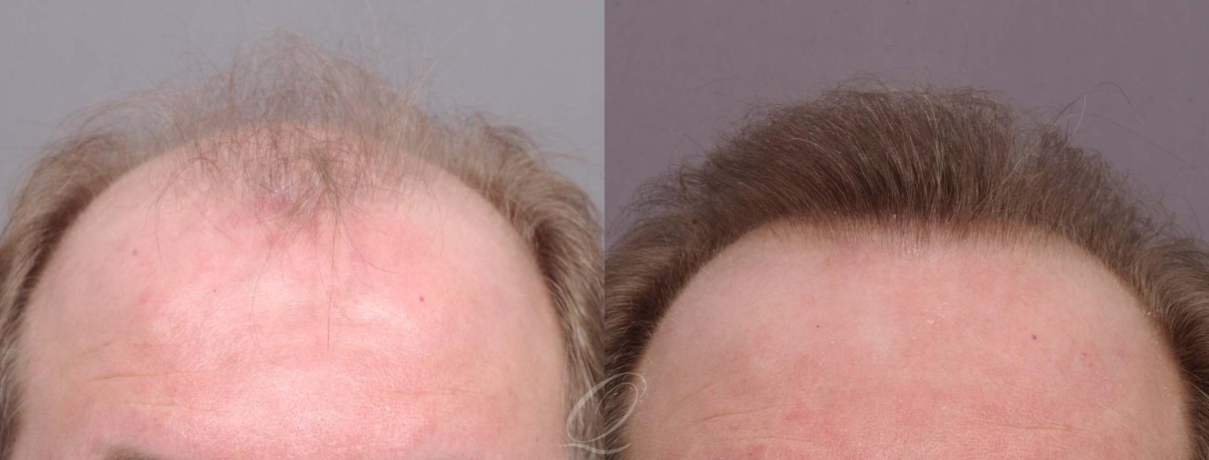 FUT Case 1034 Before & After View #1 | Rochester, Buffalo, & Syracuse, NY | Quatela Center for Hair Restoration
