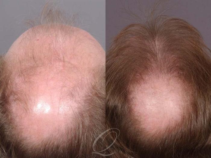 Male Hairline and Central Density Hair Restoration Case 1034 Before & After View #3 | Serving Rochester, Syracuse & Buffalo, NY | Quatela Center for Plastic Surgery