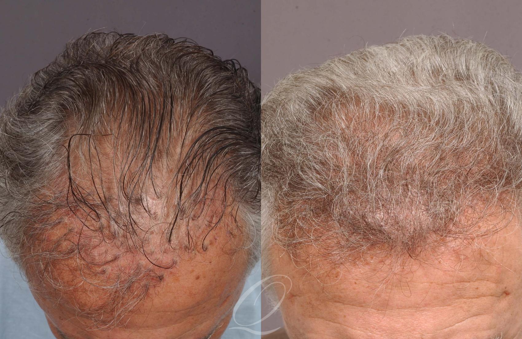 Male Hairline and Central Density Hair Restoration Case 1036 Before & After View #2 | Rochester, Buffalo, & Syracuse, NY | Quatela Center for Hair Restoration