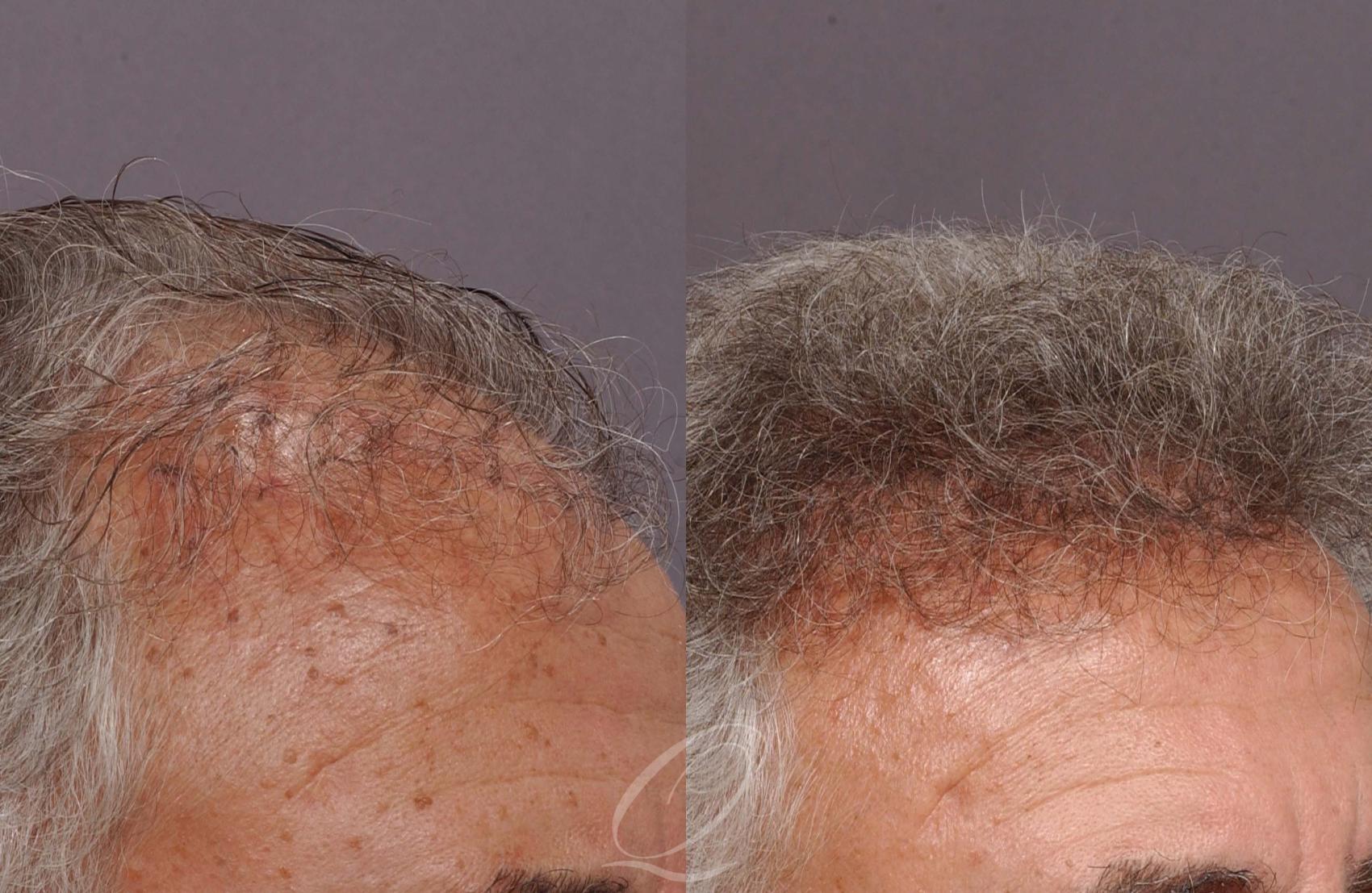 Male Hairline and Central Density Hair Restoration Case 1036 Before & After View #3 | Rochester, Buffalo, & Syracuse, NY | Quatela Center for Hair Restoration