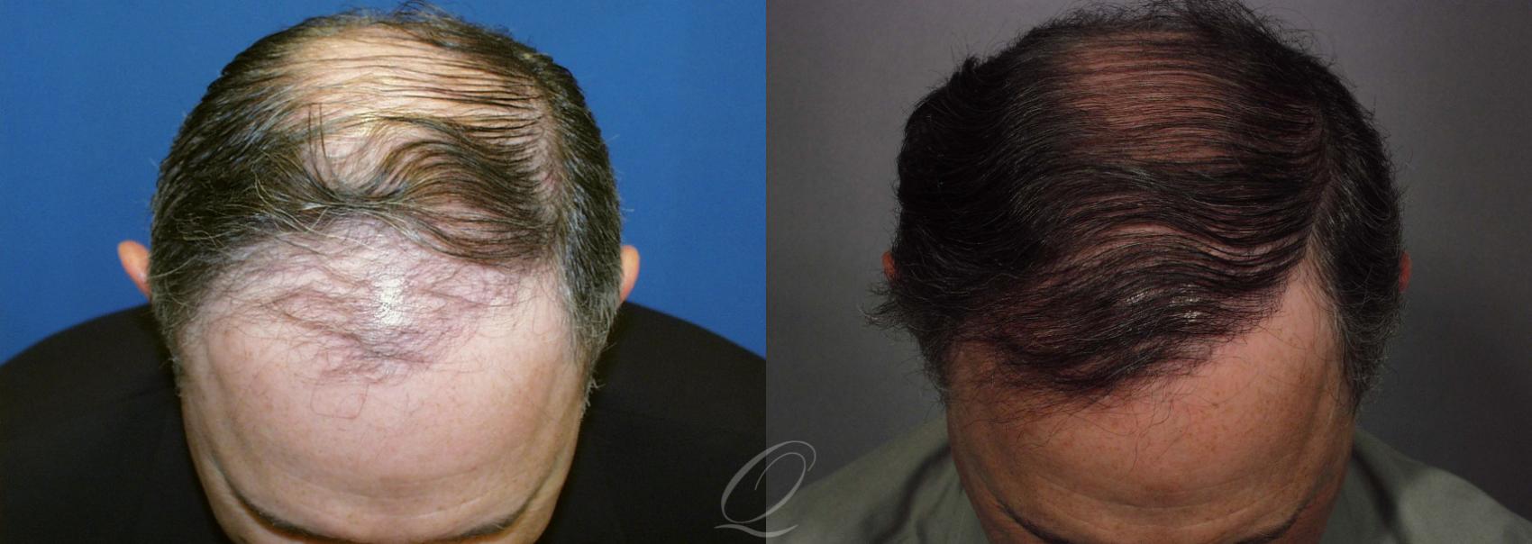 FUT Case 1039 Before & After View #1 | Rochester, NY | Quatela Center for Hair Restoration