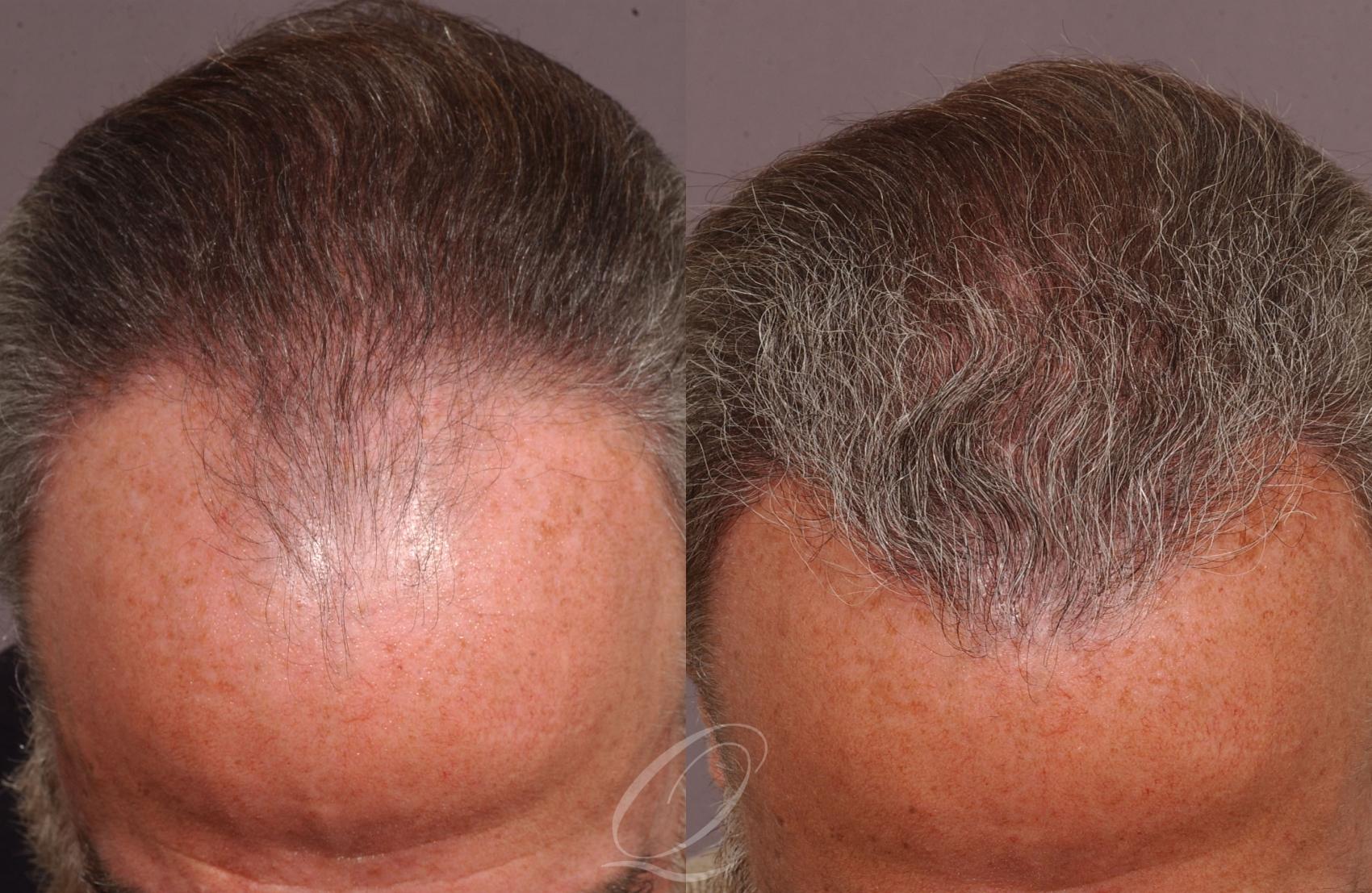 FUT Case 1040 Before & After View #1 | Rochester, Buffalo, & Syracuse, NY | Quatela Center for Hair Restoration