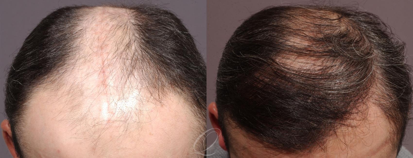 Scalp Reduction Case 1041 Before & After View #2 | Rochester, Buffalo, & Syracuse, NY | Quatela Center for Hair Restoration