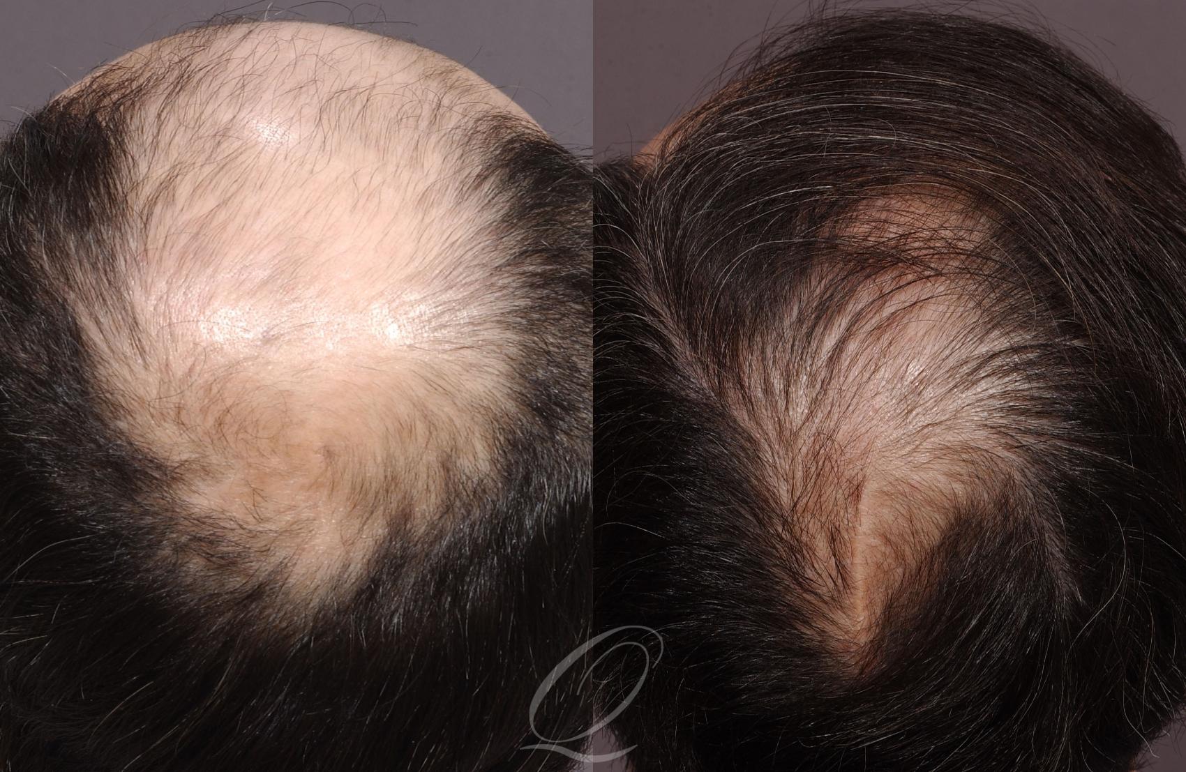 Scalp Reduction Case 1041 Before & After View #3 | Rochester, Buffalo, & Syracuse, NY | Quatela Center for Hair Restoration